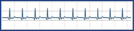 ECG-Normal v.3