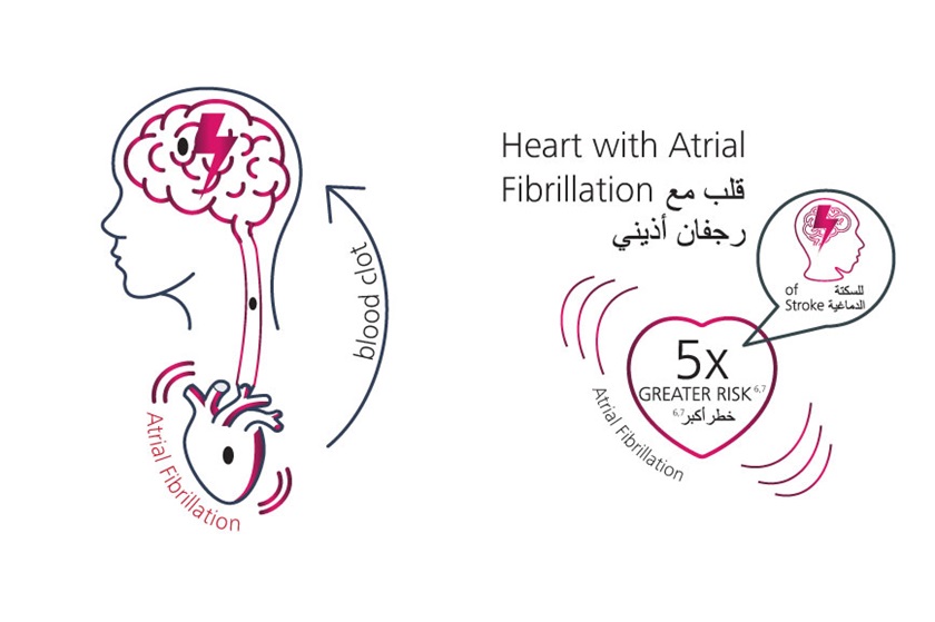 Stroke_Atrial-Fibrillation-Veroval